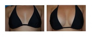 Breast Actives result